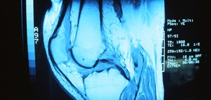 Ärztliche Zweitmeinung: Kniegelenkersatz/Knie-Endoprothese