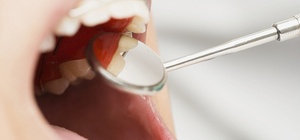 Zahnaufhellung kann umsatzsteuerfreie Heilbehandlung sein